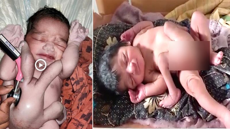 The Astonishing Ɓirth of India’s Four-Legged, Four-Armed Baby