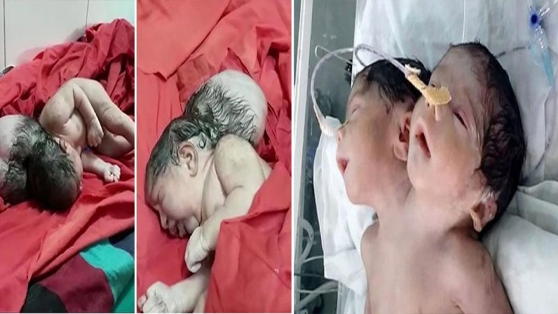 Newborn baby with 3 heads was born, Indian villagers bowed down for the incarnation of the god