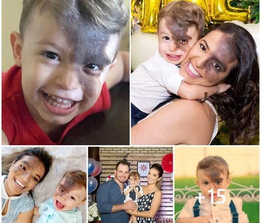 A Mother’s Unconditional Love: Empowering Her Son by Sharing His Birthmark