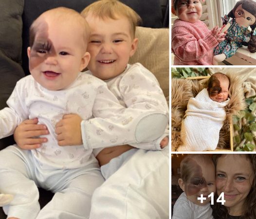 A Brother’s Touching Gesture of Love for His Sister with a Prominent Birthmark on Her Face