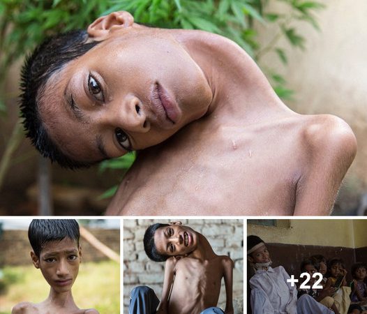 Tragic Passing of 13-Year-Old Indian Boy with 180-Degree Head Deformity, Eight Months After Life-Altering Surgery